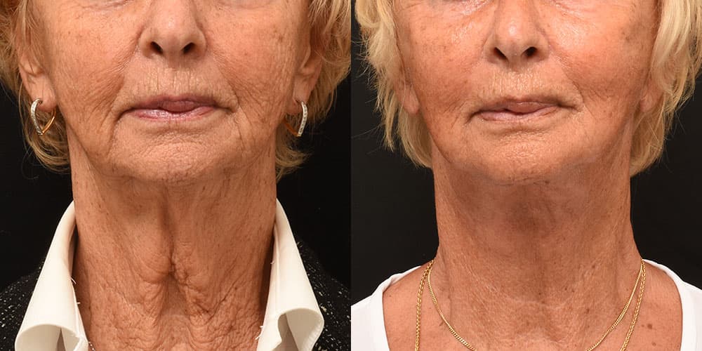 Voordelen en nadelen van een facelift