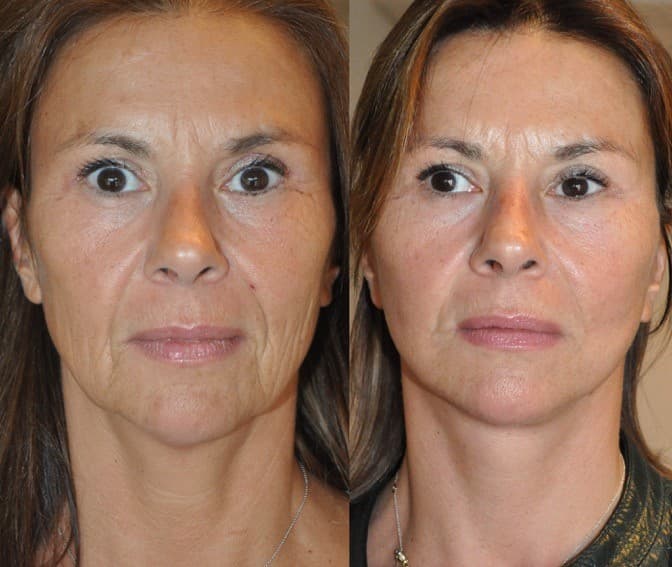Facelift anno 2015