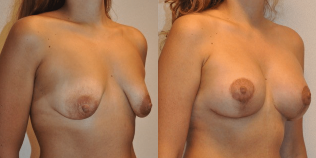 Breast lift and augmentation