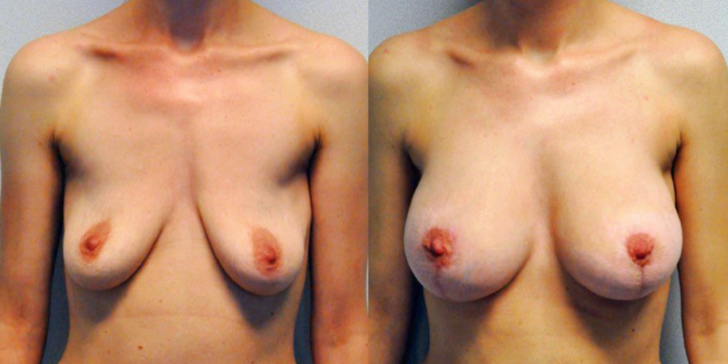 Breast lift and augmentation
