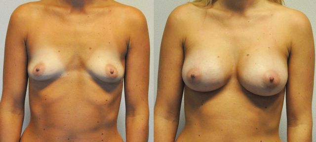 Breast augmentation before & after borstvergroting 33 door Blooming Plastic Surgery