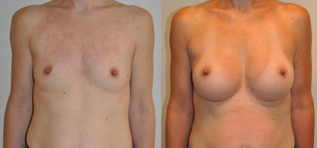 Breast augmentation before & after borstvergroting 39 door Blooming Plastic Surgery