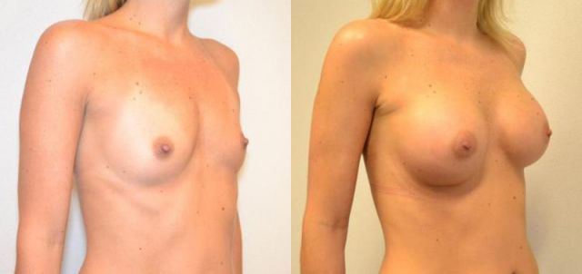 Borstvergroting voor & na borstvergroting 40 door Blooming Plastische Chirurgie