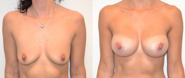 Breast augmentation before & after borstvergroting 45 door Blooming Plastic Surgery