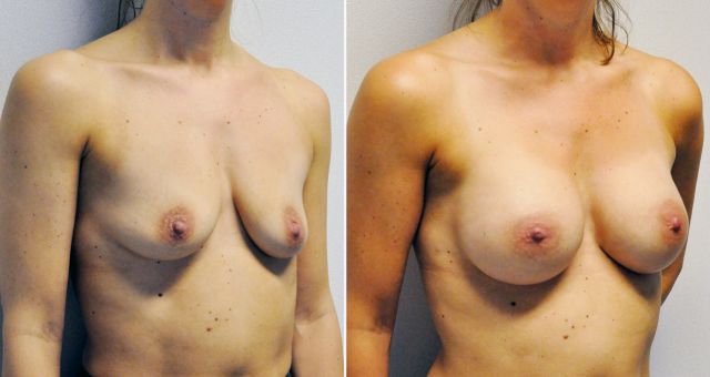 Breast augmentation before & after borstvergroting 47 door Blooming Plastic Surgery