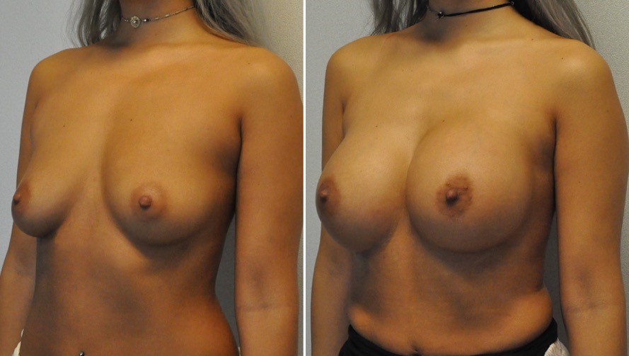 Breast augmentation before & after borstvergroting 56 door Blooming Plastic Surgery