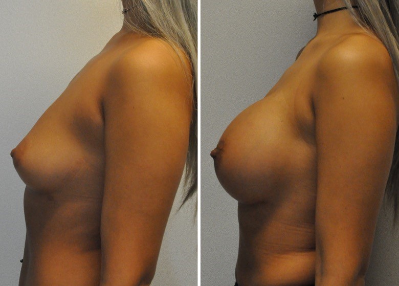 Breast augmentation before & after borstvergroting 58 door Blooming Plastic Surgery