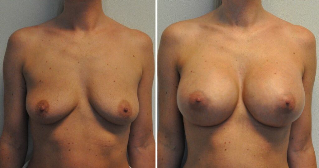Breast augmentation before & after borstvergroting 59 door Blooming Plastic Surgery