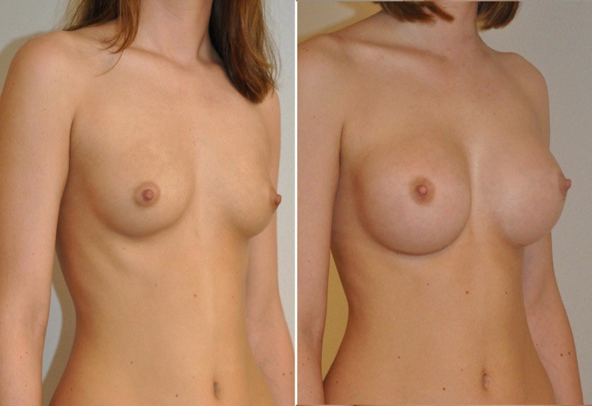 Breast augmentation before & after borstvergroting 62 door Blooming Plastic Surgery