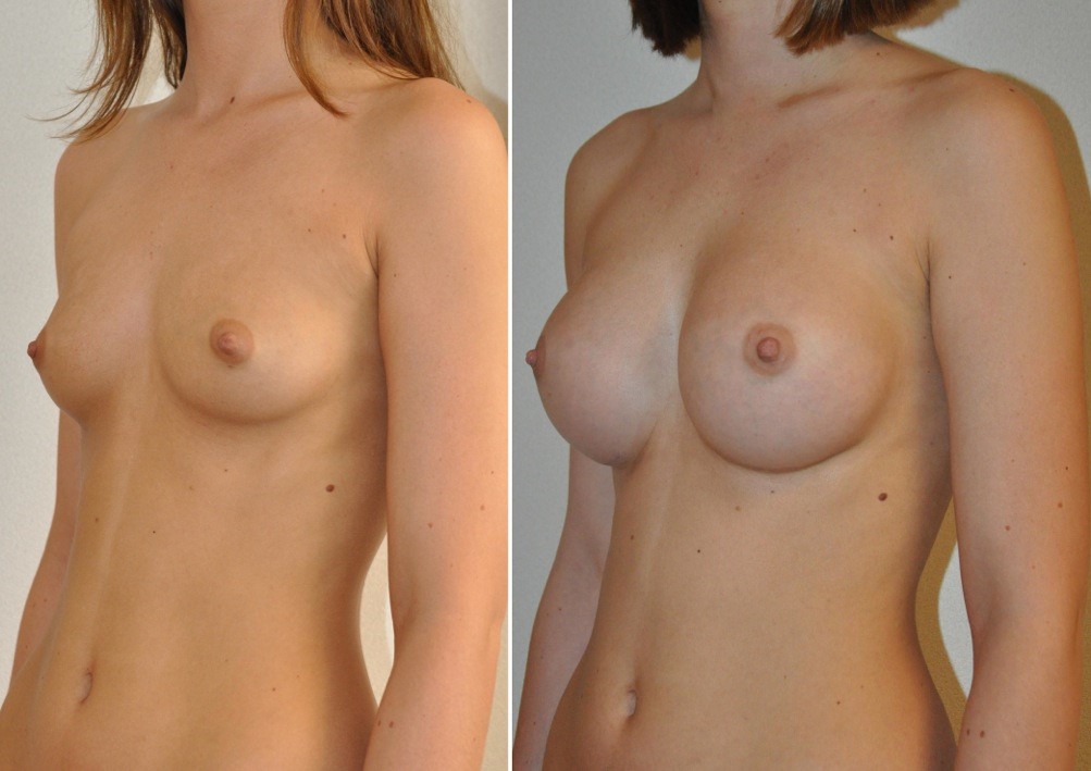Breast augmentation before & after borstvergroting 63 door Blooming Plastic Surgery
