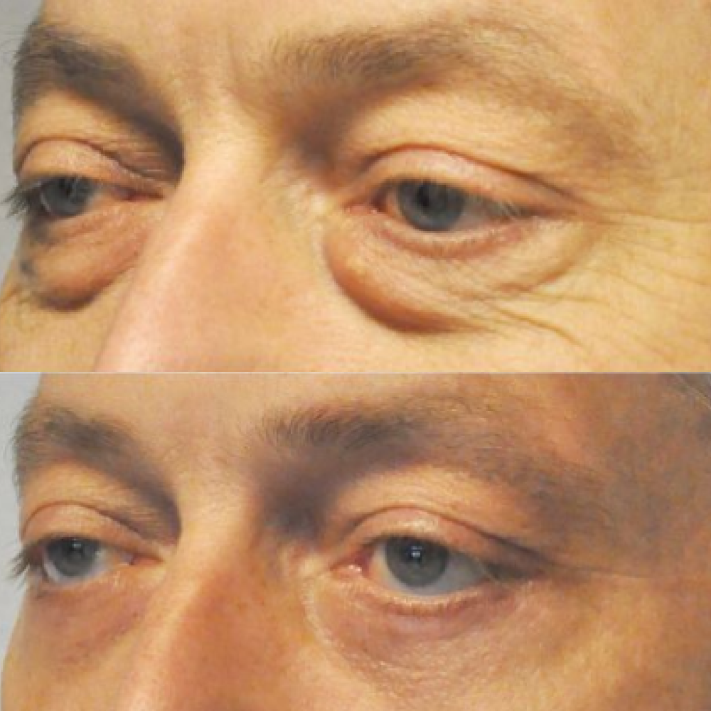 lower eyelid surgery
