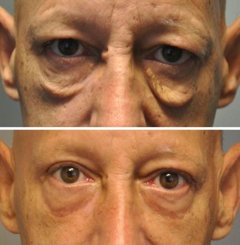 Eyelid surgery before & after ooglidcorrectie 1 1 door Blooming Plastic Surgery